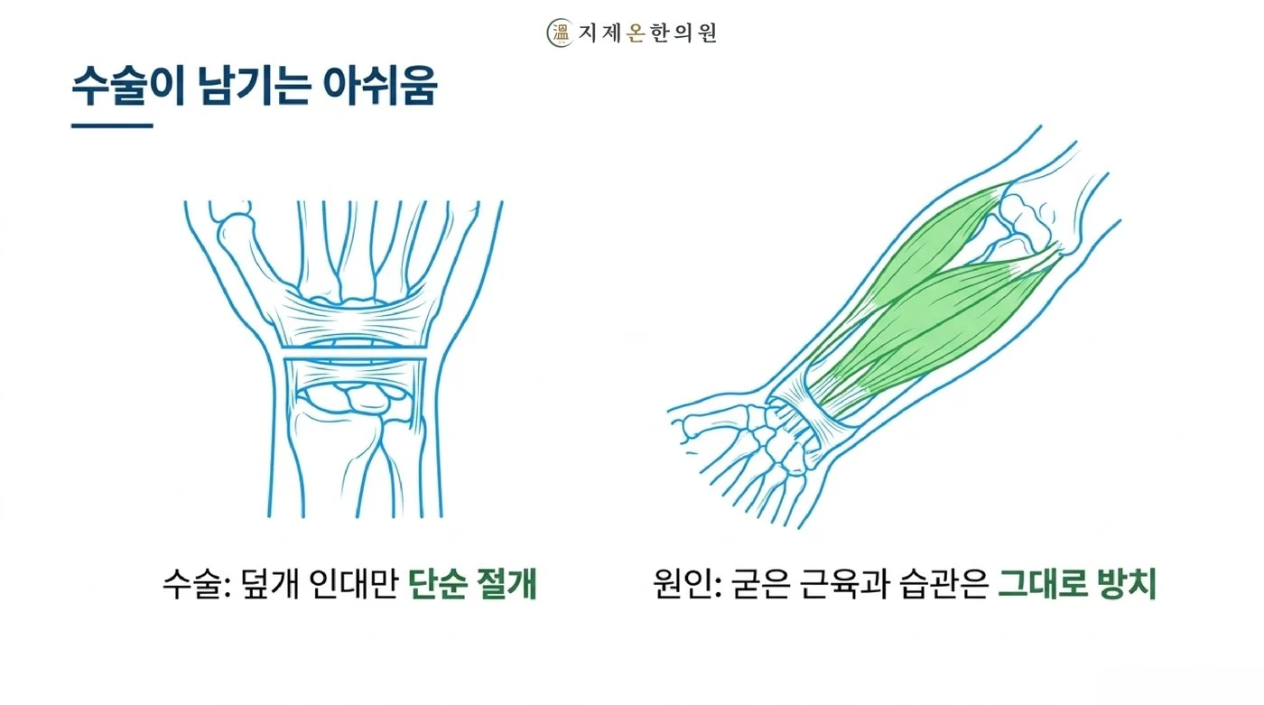수술은 덮개 인대를 열어 공간을 넓혀 주지만 굳은 근육과 손목 쓰는 습관은 그대로 남는다는 설명