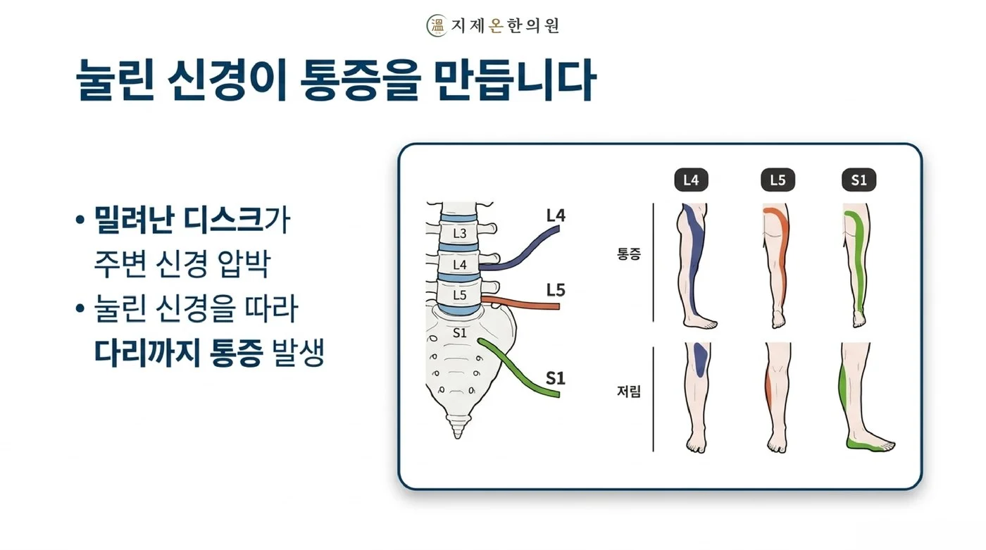 밀려난 디스크가 L4·L5·S1 신경을 누르면 그 신경이 지나는 다리 부위를 따라 통증과 저림이 생기는 원리