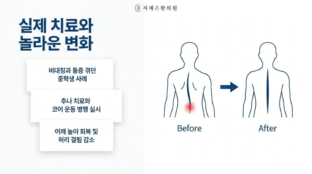 실제 치료와 놀라운 변화 - 비대칭과 통증을 겪던 학생 사례, 추나 치료와 코어 운동 병행 실시, 어깨 높이 회복 및 허리 결림 감소