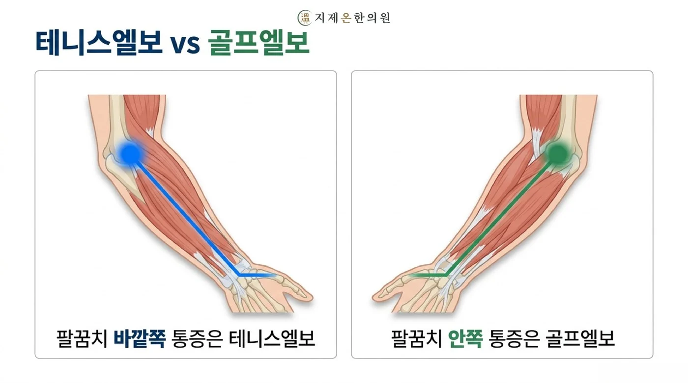 팔꿈치 바깥쪽 통증은 테니스엘보, 안쪽 통증은 골프엘보로 나뉘는 아래팔 근육 그림